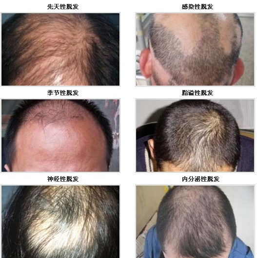 唐風(fēng)采假發(fā)中秋雙節(jié)鉅惠 脫發(fā)