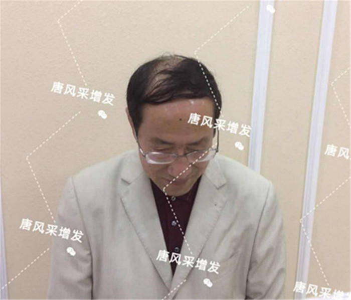 如何解決地中海脫發(fā) 謝頂