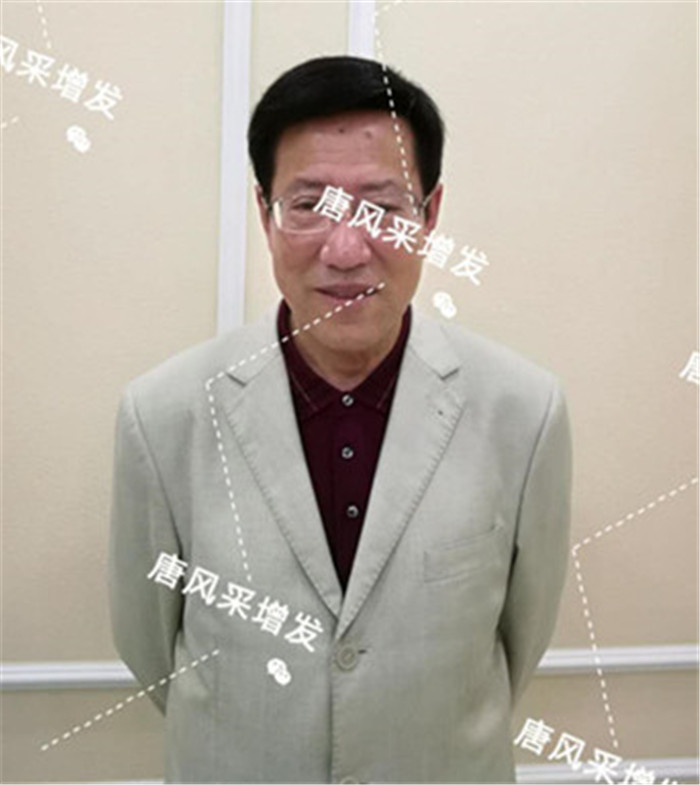 如何解決地中海脫發(fā) 唐風(fēng)采客戶案例