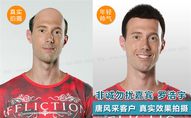 禿頂發(fā)型設計 唐風采客戶