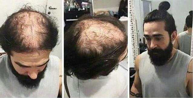 禿頂發(fā)型設計 禿頂發(fā)型設計