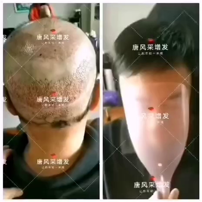 脫發(fā) 植發(fā)失敗后選擇唐風(fēng)采假發(fā)