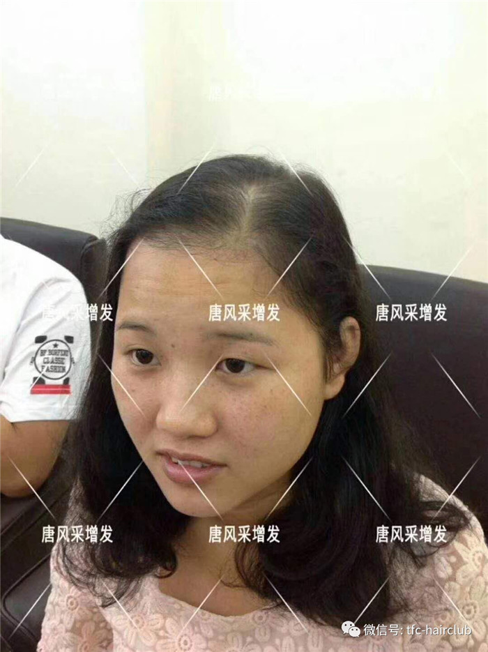 無痕補發(fā)看得出是假發(fā)嗎 唐風采客戶增發(fā)前