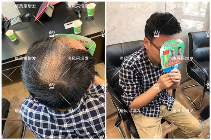 用自己的頭發(fā)定制假發(fā) \