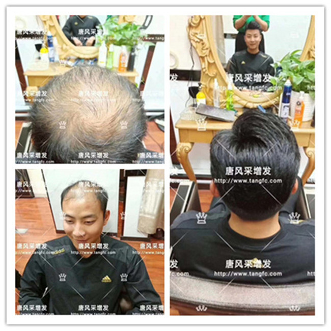 用自己的頭發(fā)定制假發(fā) \