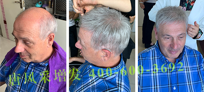 禿頂如何增發(fā) \