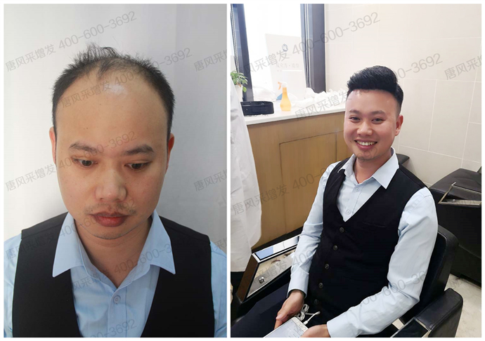 隱形男士補發(fā)塊 \