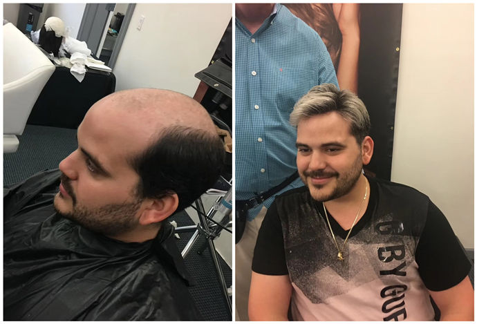 蓋頭頂男士假發(fā)片 \