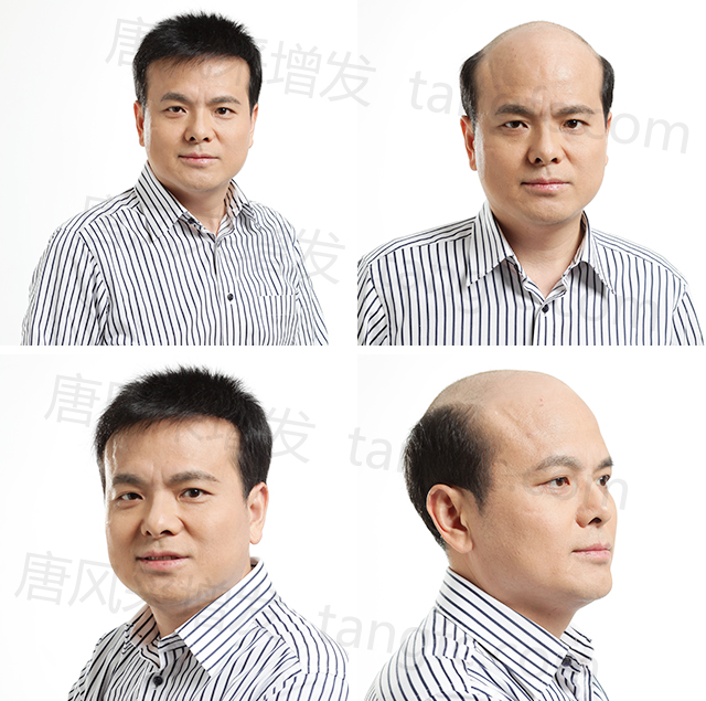 局部假發(fā)織發(fā) \